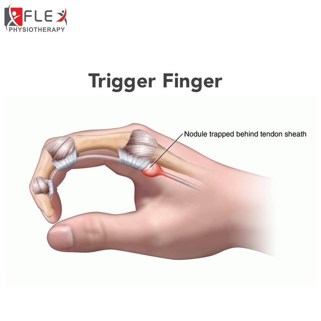 Lima gejala trigger finger