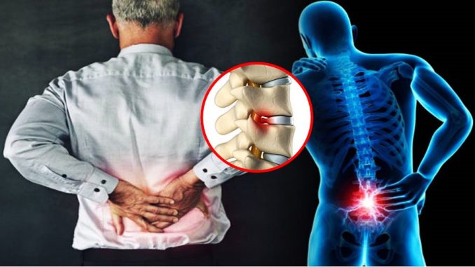 Mitos atau fakta: Edisi Skoliosis