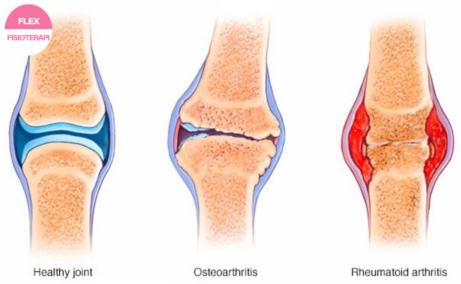 Sakit lutut osteoarthritis dalam kalangan orang tua
