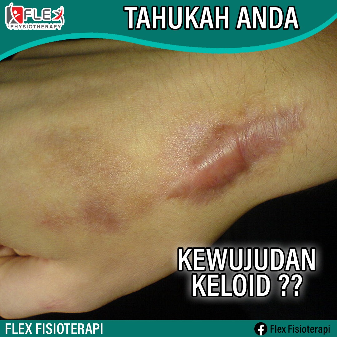 Tahukah Anda Kewujudan Keloid?