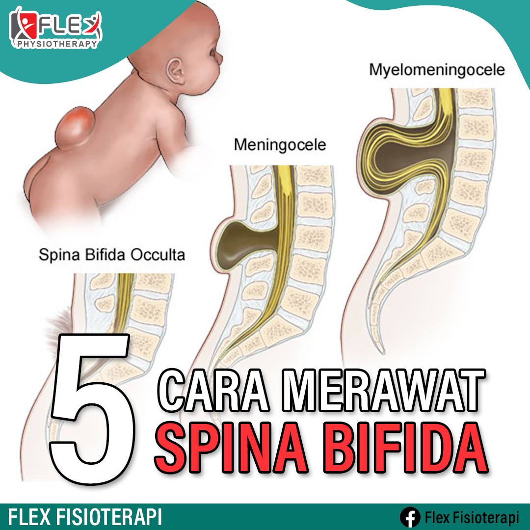 Macam Mana Nak Rawat Spina Bifida?